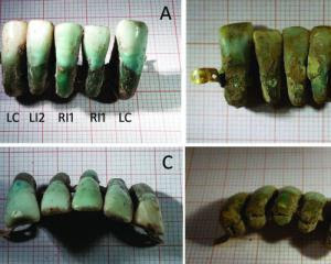 В Италии заметили протез из настоящих зубов из Средневековья  