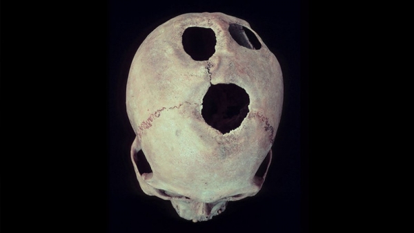 В Китае трепанацию черепа мастерили более 3,5 тысяч лет назад  
